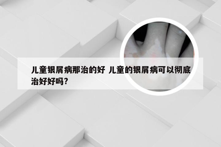 儿童银屑病那治的好 儿童的银屑病可以彻底治好好吗?