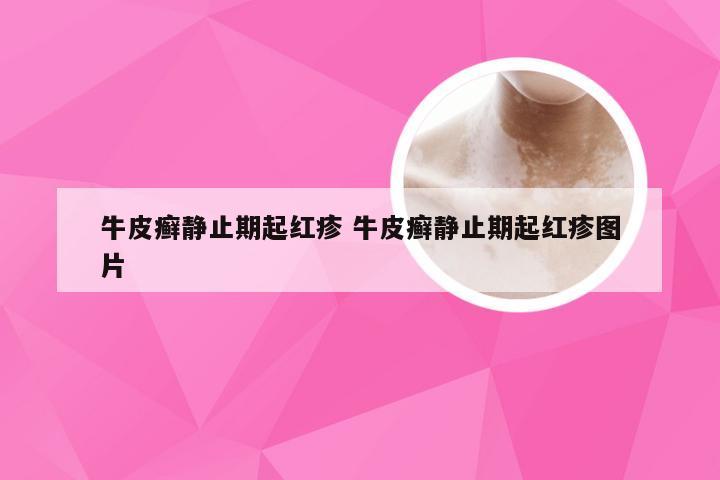牛皮癣静止期起红疹 牛皮癣静止期起红疹图片
