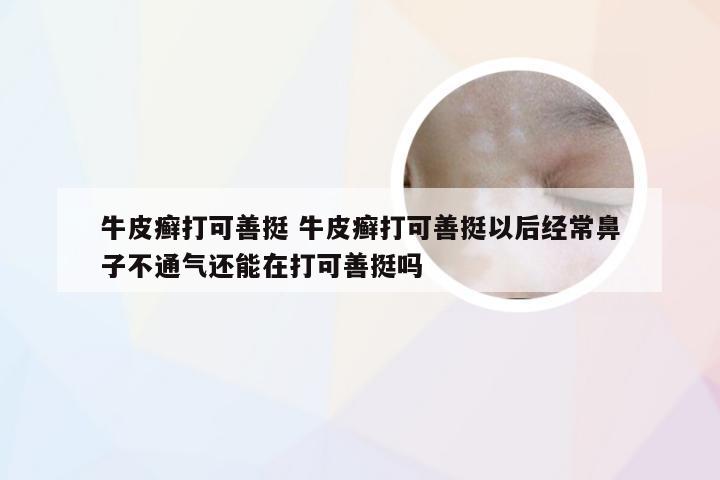 牛皮癣打可善挺 牛皮癣打可善挺以后经常鼻子不通气还能在打可善挺吗