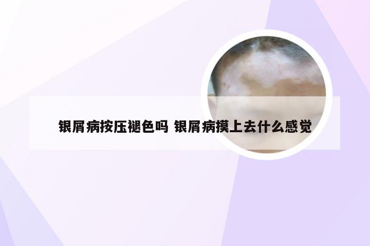 银屑病按压褪色吗 银屑病摸上去什么感觉
