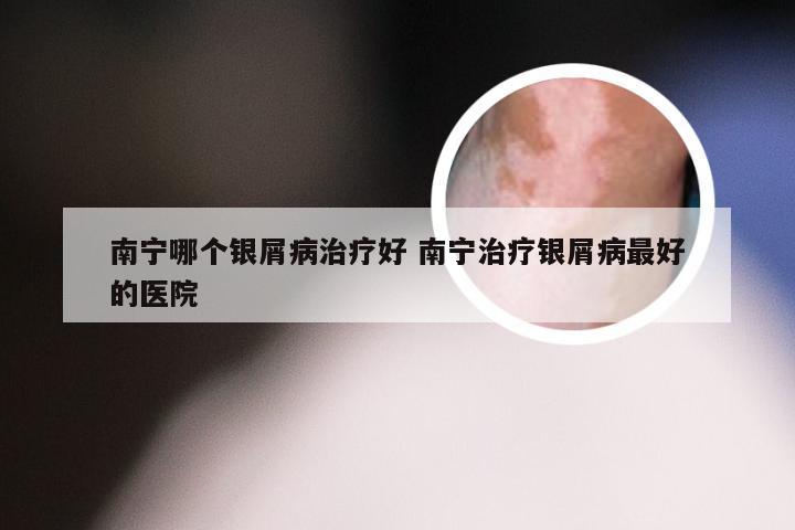 南宁哪个银屑病治疗好 南宁治疗银屑病最好的医院