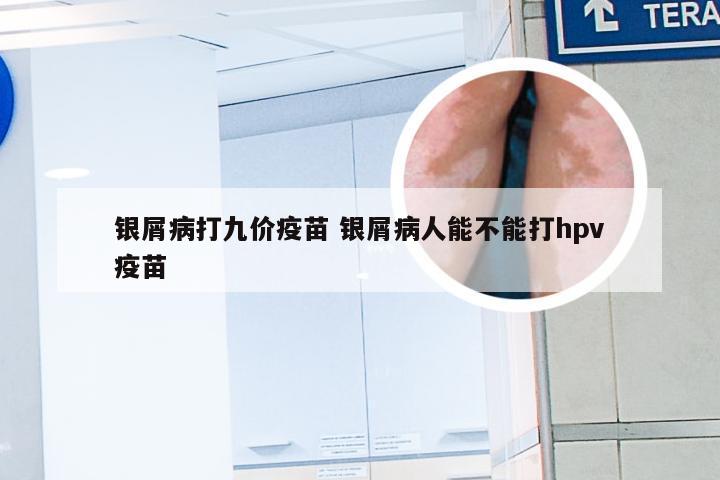 银屑病打九价疫苗 银屑病人能不能打hpv疫苗