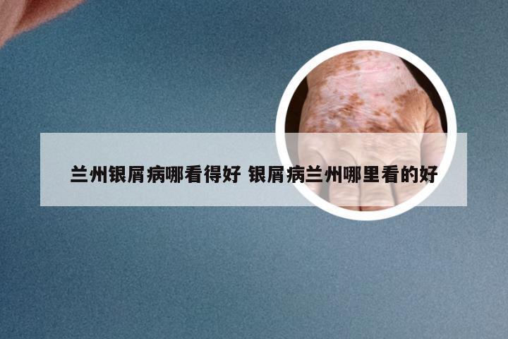兰州银屑病哪看得好 银屑病兰州哪里看的好