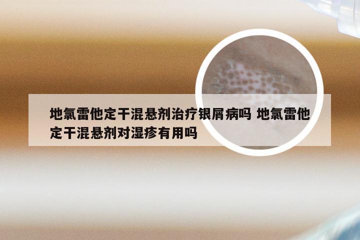 地氯雷他定干混悬剂治疗银屑病吗 地氯雷他定干混悬剂对湿疹有用吗