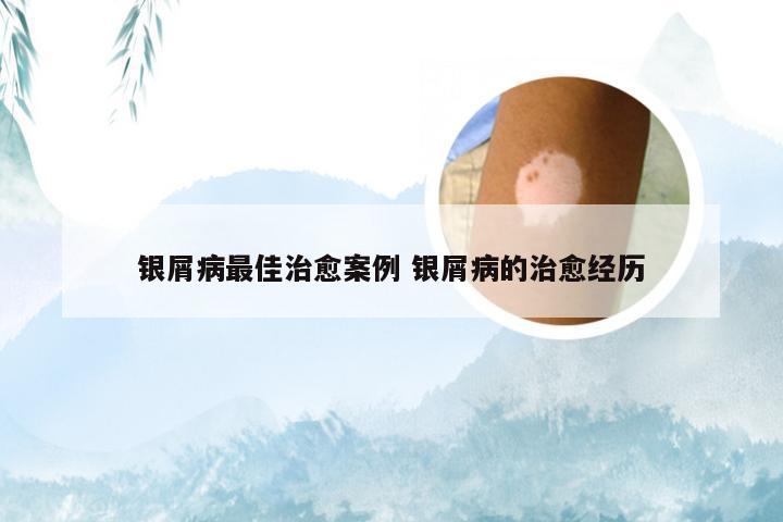 银屑病最佳治愈案例 银屑病的治愈经历