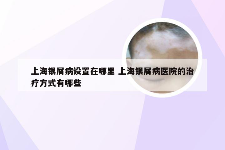 上海银屑病设置在哪里 上海银屑病医院的治疗方式有哪些