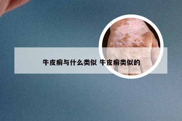 牛皮癣与什么类似 牛皮癣类似的