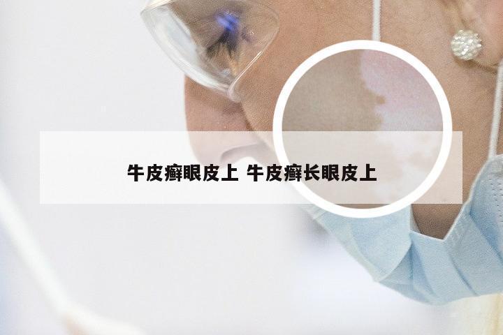 牛皮癣眼皮上 牛皮癣长眼皮上