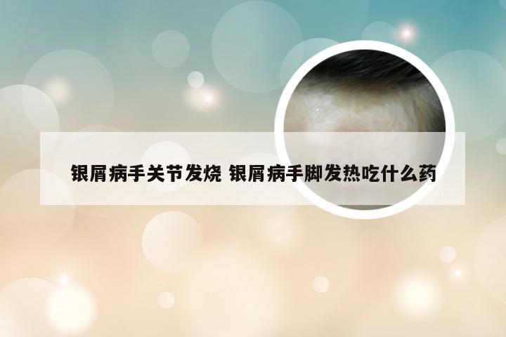 银屑病手关节发烧 银屑病手脚发热吃什么药