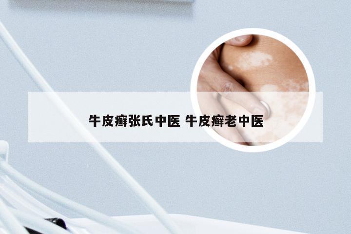 牛皮癣张氏中医 牛皮癣老中医
