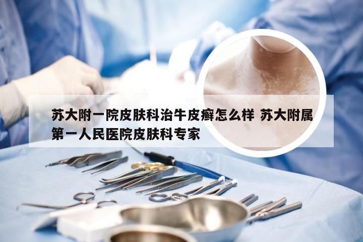 苏大附一院皮肤科治牛皮癣怎么样 苏大附属第一人民医院皮肤科专家