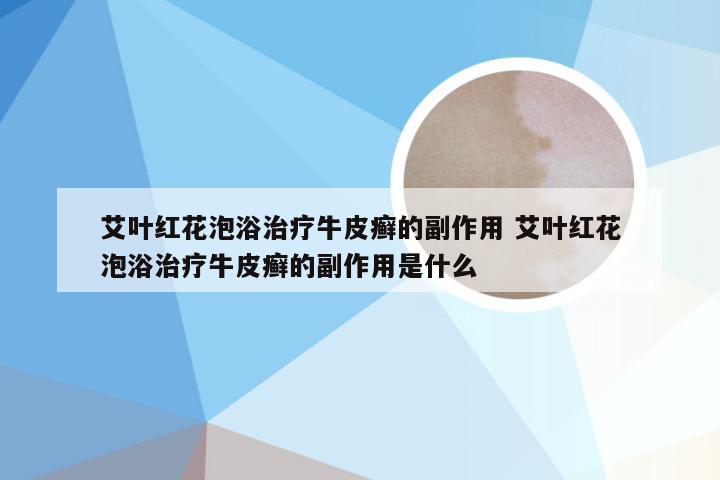 艾叶红花泡浴治疗牛皮癣的副作用 艾叶红花泡浴治疗牛皮癣的副作用是什么