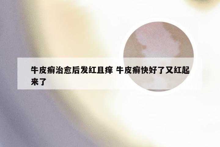 牛皮癣治愈后发红且痒 牛皮癣快好了又红起来了