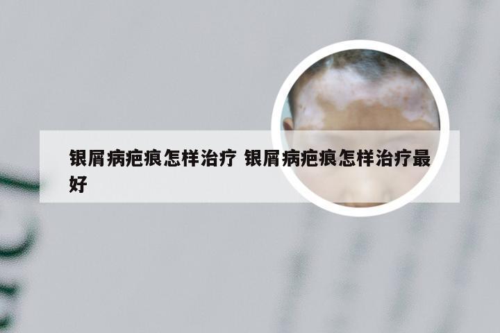 银屑病疤痕怎样治疗 银屑病疤痕怎样治疗最好
