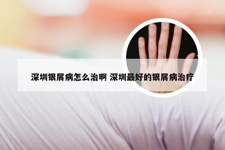 深圳银屑病怎么治啊 深圳最好的银屑病治疗
