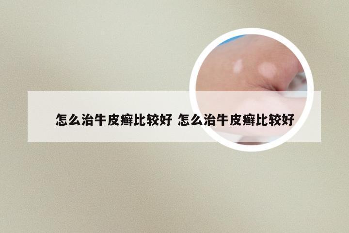 怎么治牛皮癣比较好 怎么治牛皮癣比较好