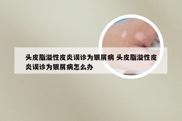 头皮脂溢性皮炎误诊为银屑病 头皮脂溢性皮炎误诊为银屑病怎么办