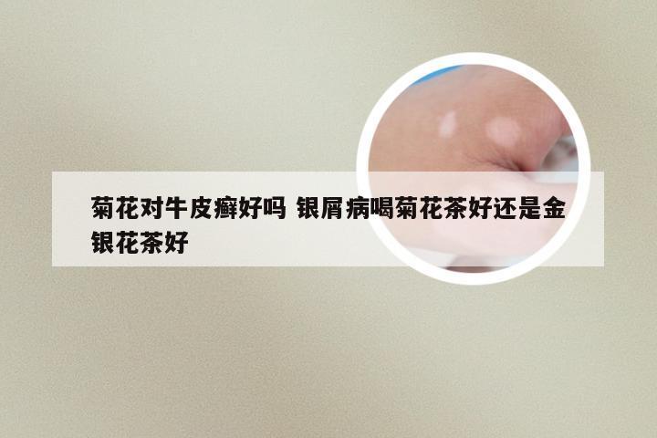 菊花对牛皮癣好吗 银屑病喝菊花茶好还是金银花茶好