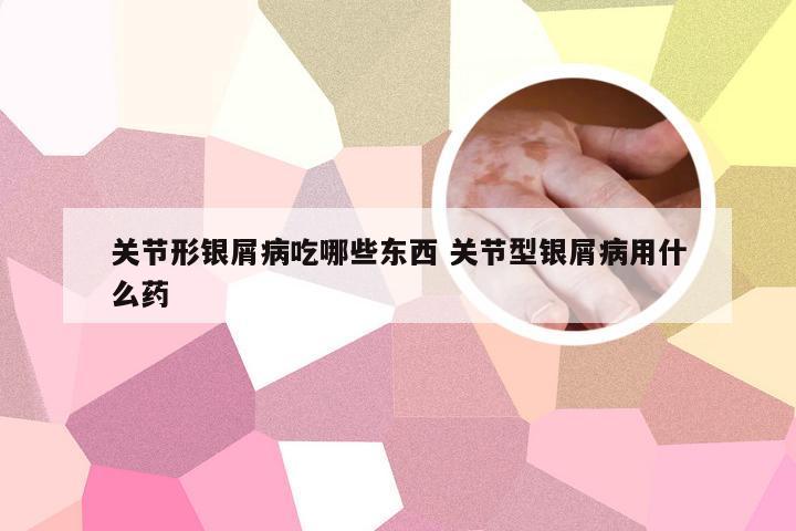 关节形银屑病吃哪些东西 关节型银屑病用什么药