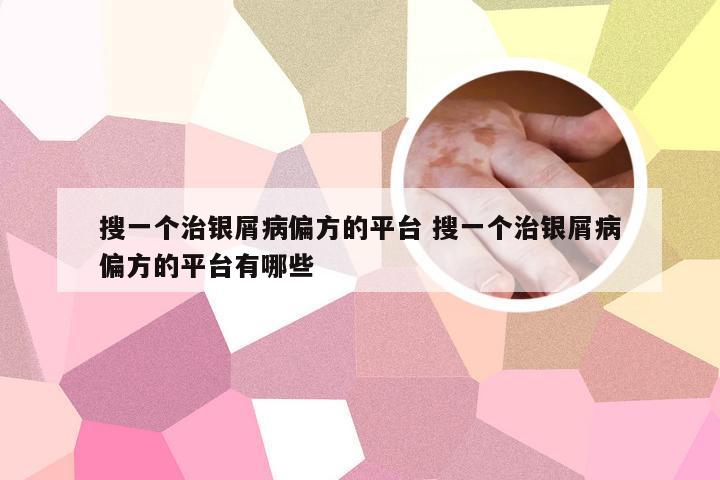搜一个治银屑病偏方的平台 搜一个治银屑病偏方的平台有哪些