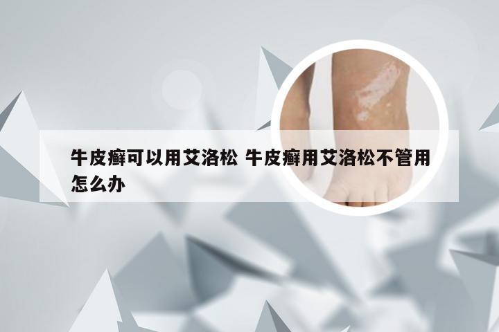 牛皮癣可以用艾洛松 牛皮癣用艾洛松不管用怎么办