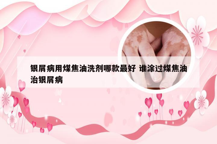 银屑病用煤焦油洗剂哪款最好 谁涂过煤焦油治银屑病