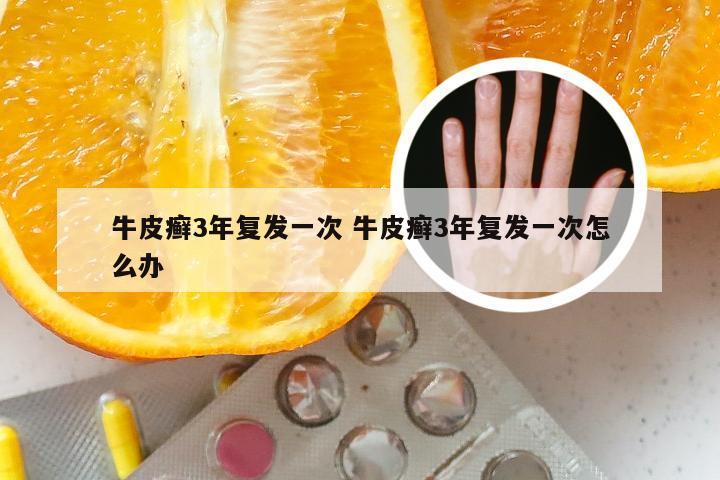 牛皮癣3年复发一次 牛皮癣3年复发一次怎么办