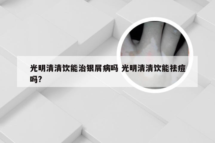 光明清清饮能治银屑病吗 光明清清饮能祛痘吗?