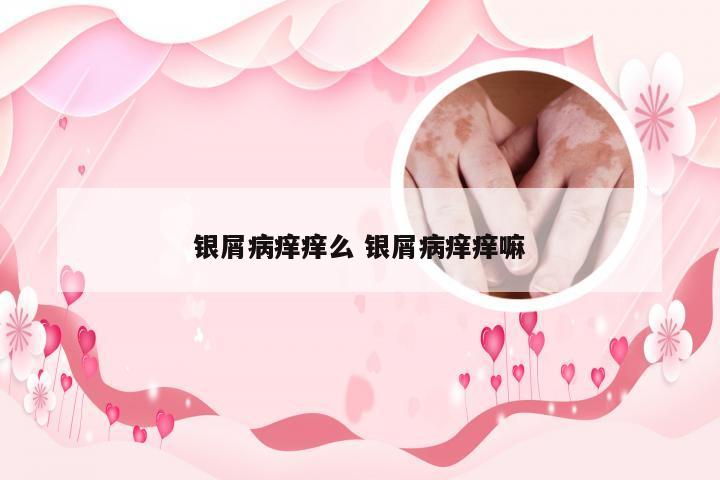 银屑病痒痒么 银屑病痒痒嘛