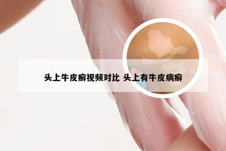 头上牛皮癣视频对比 头上有牛皮病癣