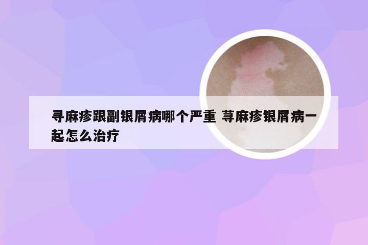 寻麻疹跟副银屑病哪个严重 荨麻疹银屑病一起怎么治疗