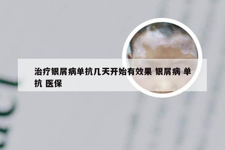 治疗银屑病单抗几天开始有效果 银屑病 单抗 医保