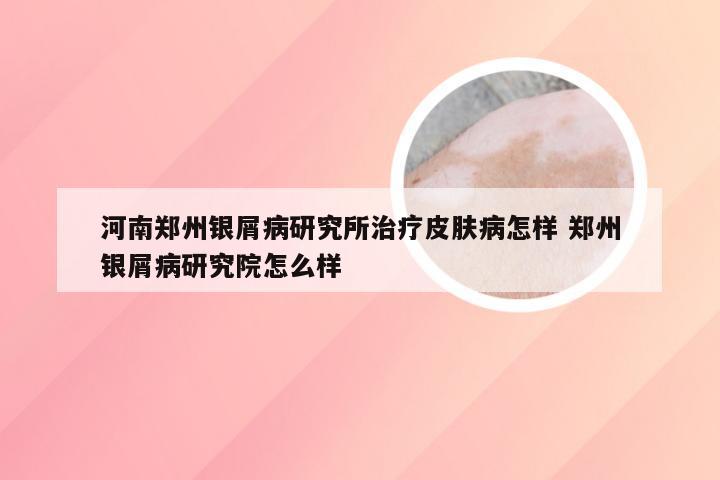 河南郑州银屑病研究所治疗皮肤病怎样 郑州银屑病研究院怎么样