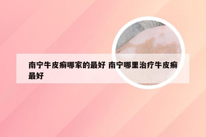 南宁牛皮癣哪家的最好 南宁哪里治疗牛皮癣最好