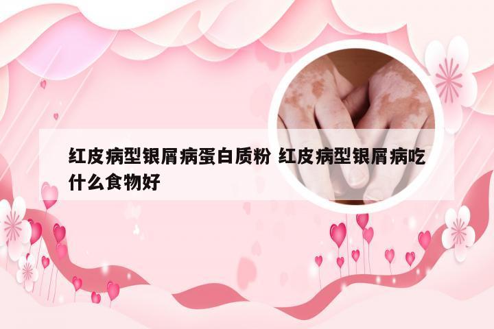 红皮病型银屑病蛋白质粉 红皮病型银屑病吃什么食物好