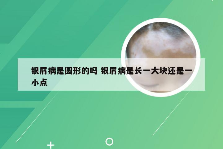 银屑病是圆形的吗 银屑病是长一大块还是一小点