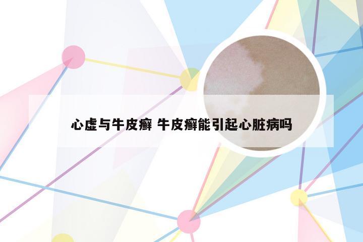 心虚与牛皮癣 牛皮癣能引起心脏病吗