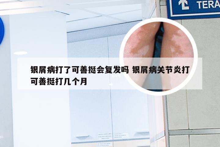 银屑病打了可善挺会复发吗 银屑病关节炎打可善挺打几个月