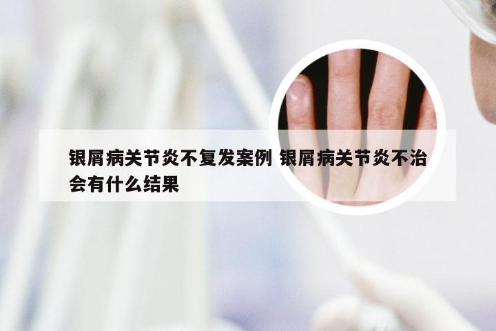 银屑病关节炎不复发案例 银屑病关节炎不治会有什么结果