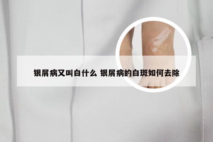 银屑病又叫白什么 银屑病的白斑如何去除