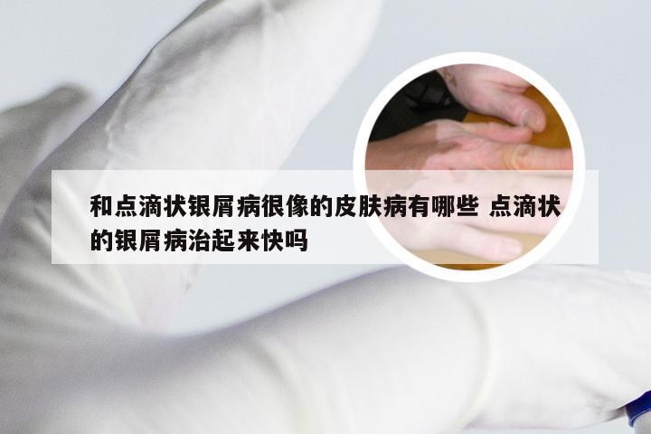 和点滴状银屑病很像的皮肤病有哪些 点滴状的银屑病治起来快吗