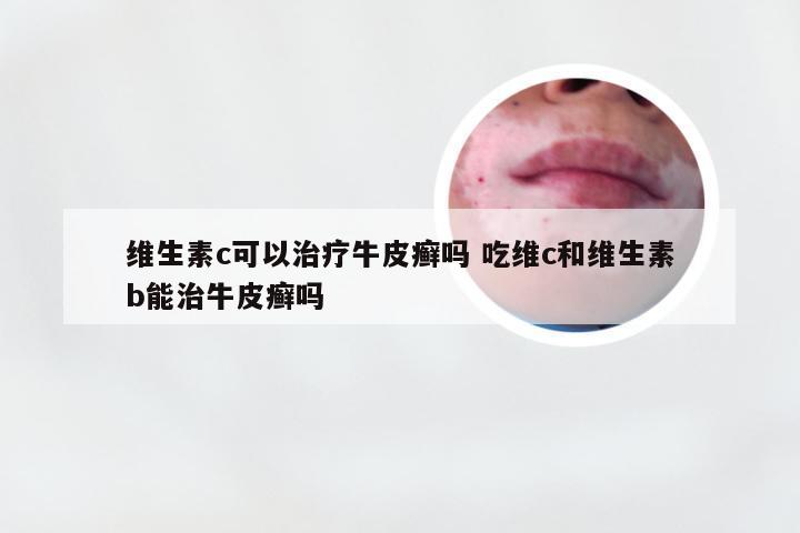 维生素c可以治疗牛皮癣吗 吃维c和维生素b能治牛皮癣吗
