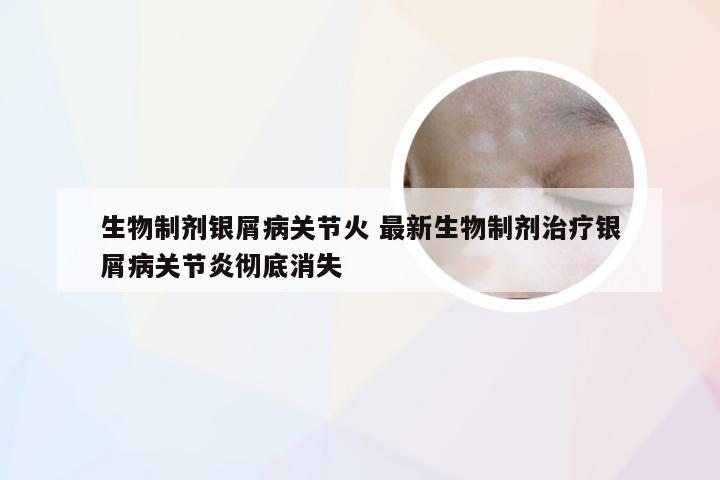 生物制剂银屑病关节火 最新生物制剂治疗银屑病关节炎彻底消失