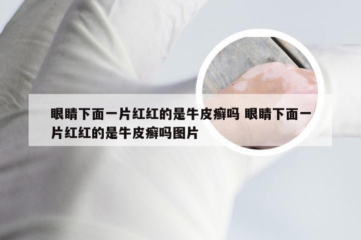 眼睛下面一片红红的是牛皮癣吗 眼睛下面一片红红的是牛皮癣吗图片