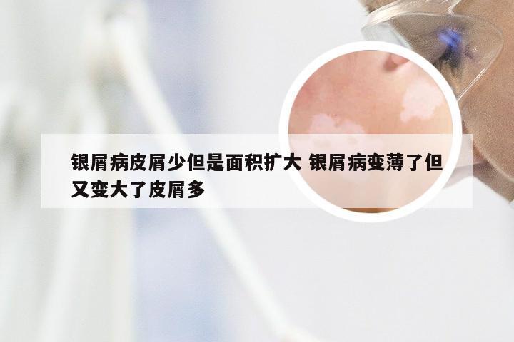 银屑病皮屑少但是面积扩大 银屑病变薄了但又变大了皮屑多