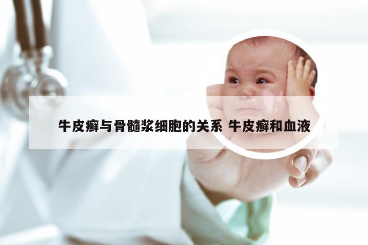 牛皮癣与骨髓浆细胞的关系 牛皮癣和血液