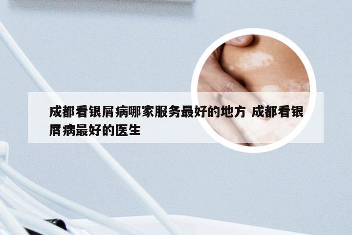 成都看银屑病哪家服务最好的地方 成都看银屑病最好的医生
