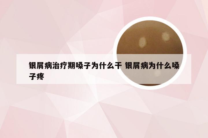 银屑病治疗期嗓子为什么干 银屑病为什么嗓子疼