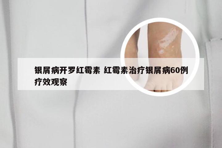 银屑病开罗红霉素 红霉素治疗银屑病60例疗效观察