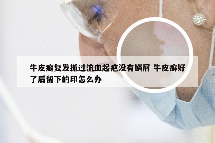 牛皮癣复发抓过流血起疤没有鳞屑 牛皮癣好了后留下的印怎么办